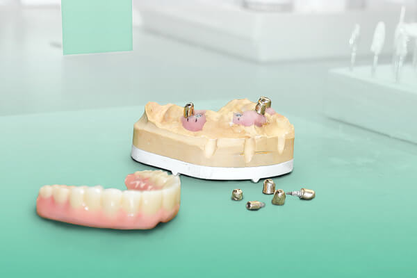 Hochwertiger und langlebiger Zahnersatz durch Implantate